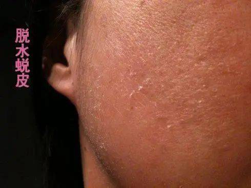 脸上角质层过薄如何增厚角质层