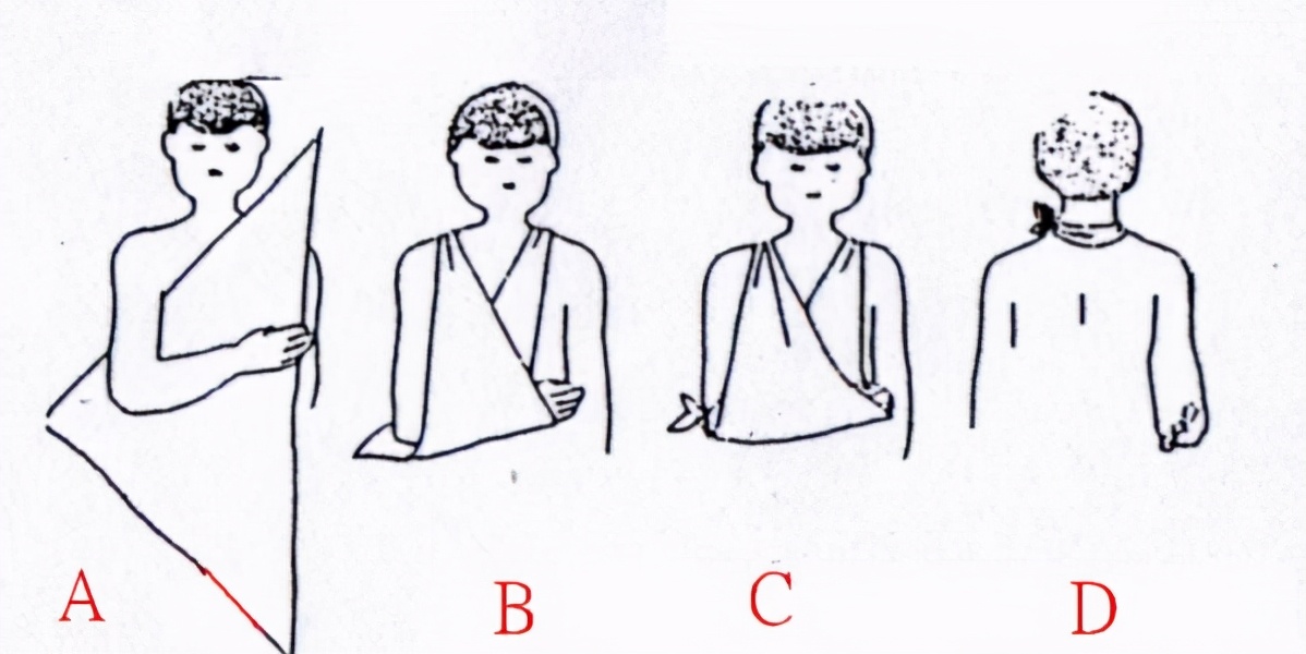 3,立即设法将脱位的肢体进行固定,可以采取用三角巾悬挂手臂等制动的
