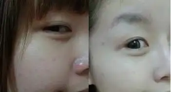 注射美白针前后的效果对比图