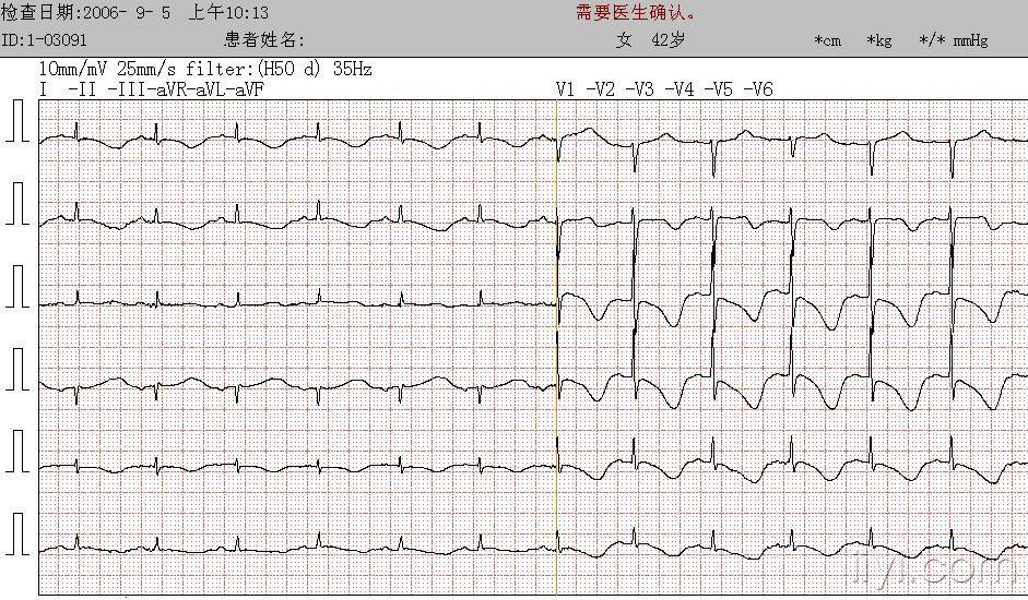 尼加拉瓜(niagara)大瀑布式巨型t波 - 心电图脑电图专业讨论版 - 爱爱