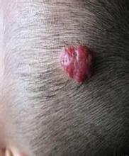 头皮肿瘤 - 好大夫在线