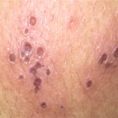 龟头珍珠疹有多少人有?