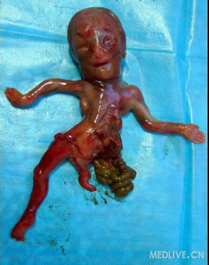 羊膜带综合征一例见图