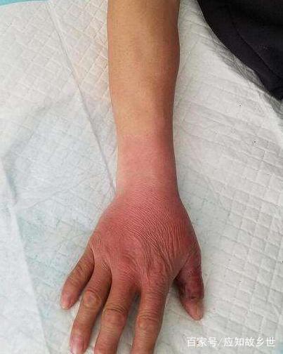 不敢相信!一男子被毒蛇咬伤,自行处理伤口并喝酒,出现异常!