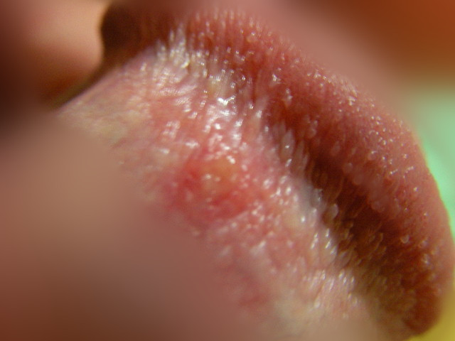 生殖感染疱疹炎图片 (27)