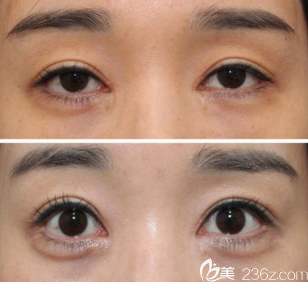 双眼皮的疤痕如何修复?