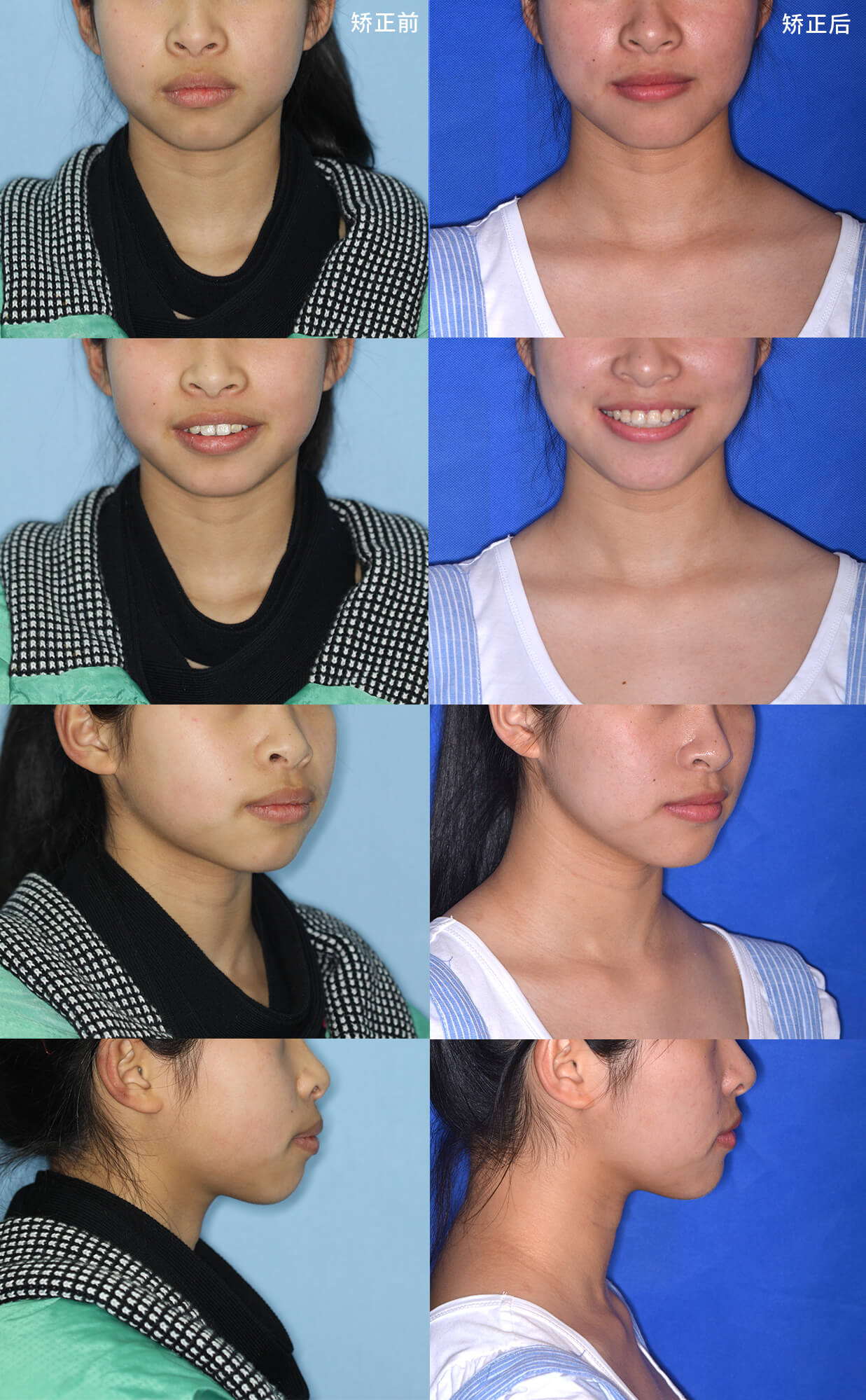 牙齿整齐但嘴突?牙齿矫正同样有效!