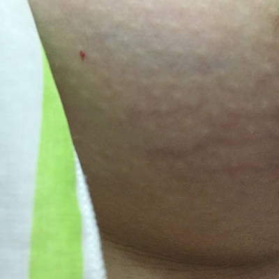 今天突然发现胸上面多了几条,会不会是妊娠纹啊,怎麼办啊怎麼办