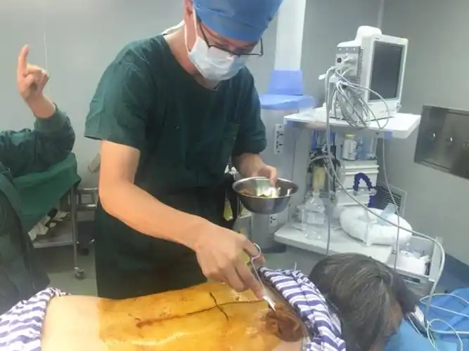 骨质疏松症引起的第八胸椎压缩性骨折经皮椎体成形术,手术时间40分钟