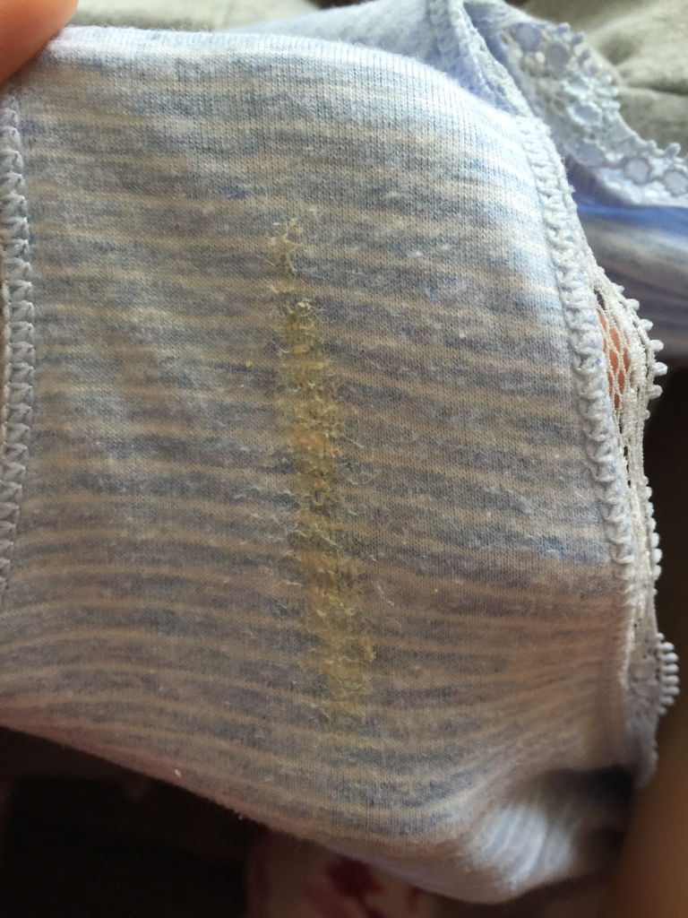 有些时候左边小腹有点疼,内裤总是黄黄的,白带干在内裤上黄黄干干的