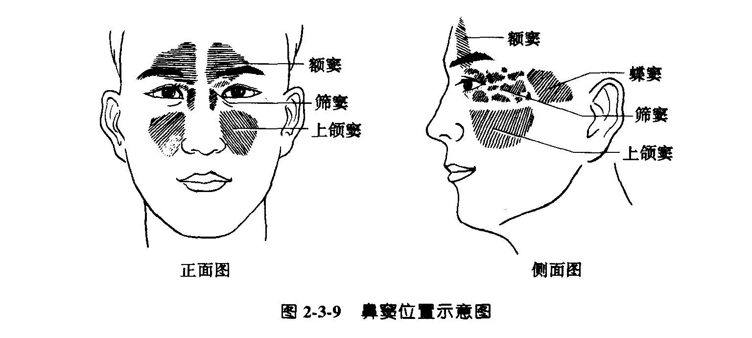 双侧上颌窦炎伴液体潴留是什么意思
