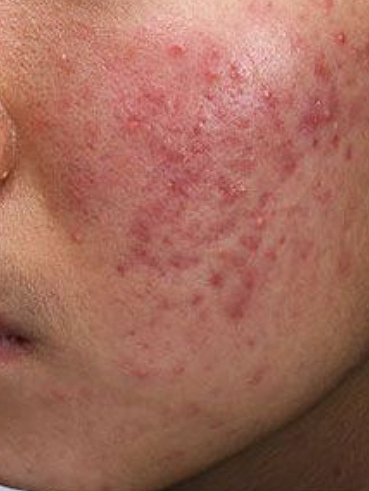 这位患者经面诊是痤疮,脂溢性皮炎,曾经应用可疑含激素护肤品,皮肤