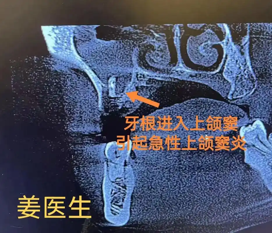 急性上颌窦炎.——"小舍小得,不舍不得,大舍大得" 外院转诊 - 抖音