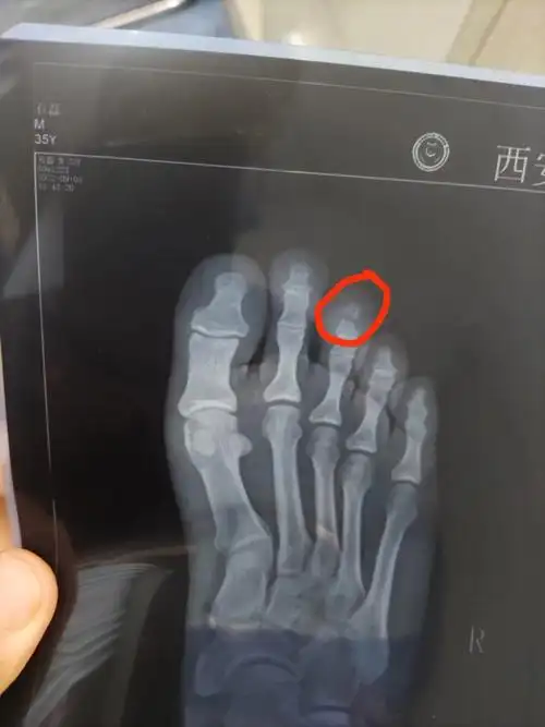 脚趾骨折让我错失了今年最美好季节
