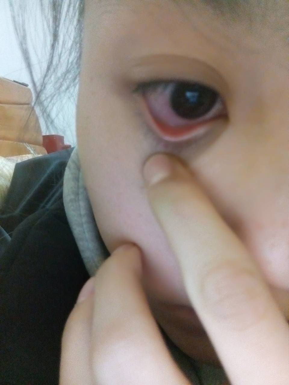 隐形眼镜大概隔了半个月没戴,前天刚戴的然后下午就发现眼角红了,不疼