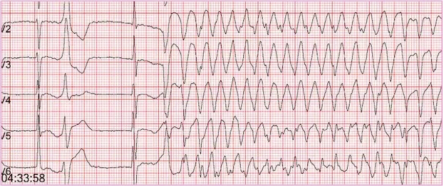 心室波形规律,快速,连续,波幅大,呈"正弦曲线样",频率150~300次/分