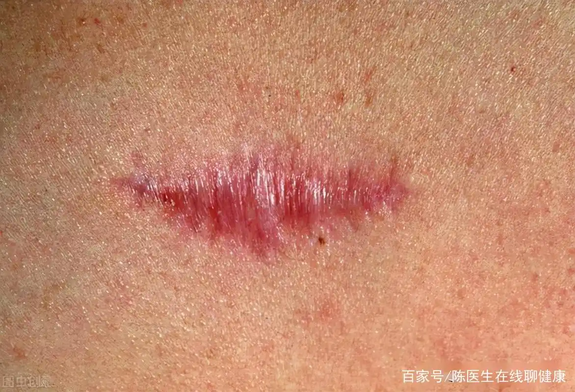 夺去赵忠祥生命的"鳞状细胞癌",听起来陌生,实际却很常见