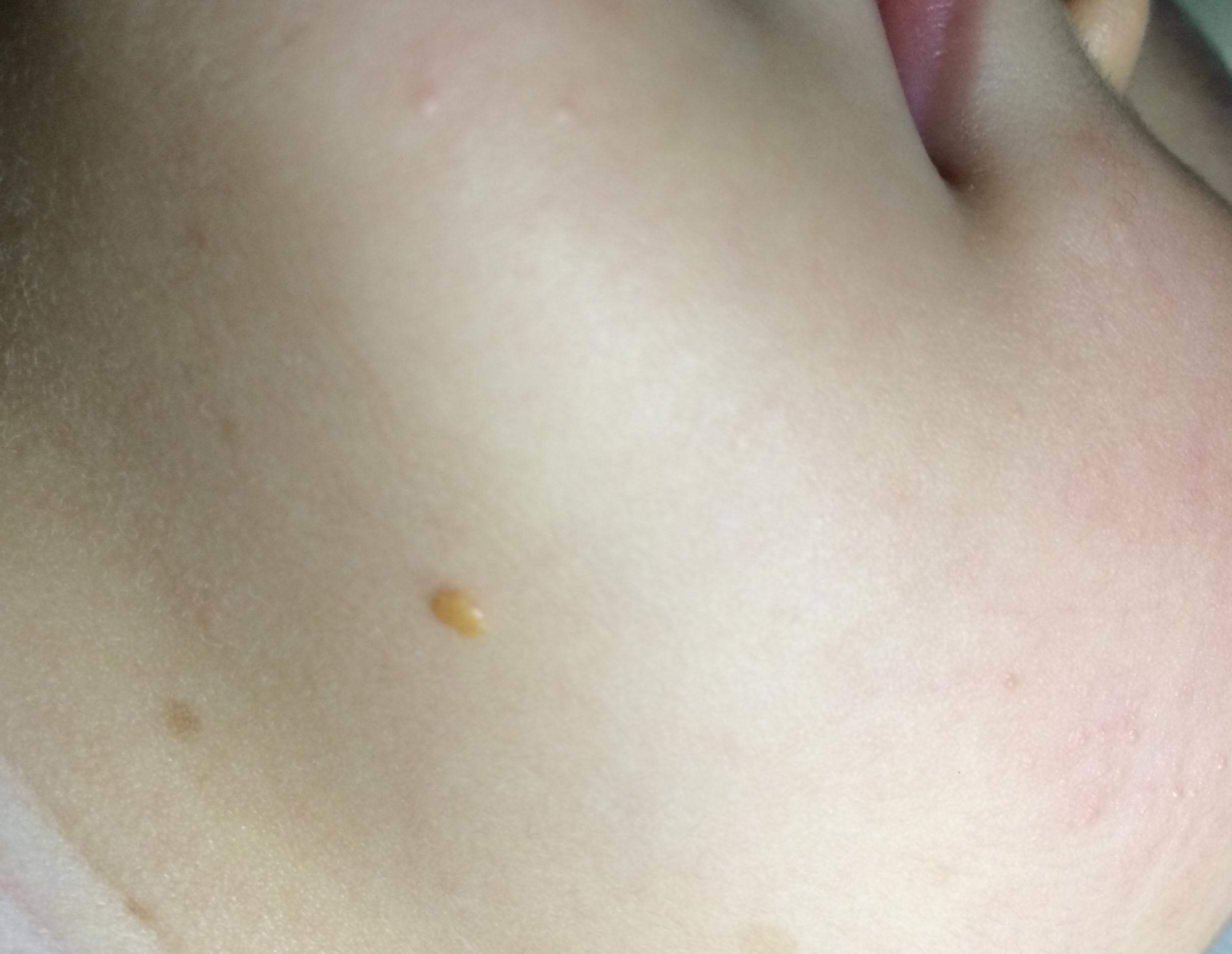 哪些皮肤表现需要高度警惕神经纤维瘤病?