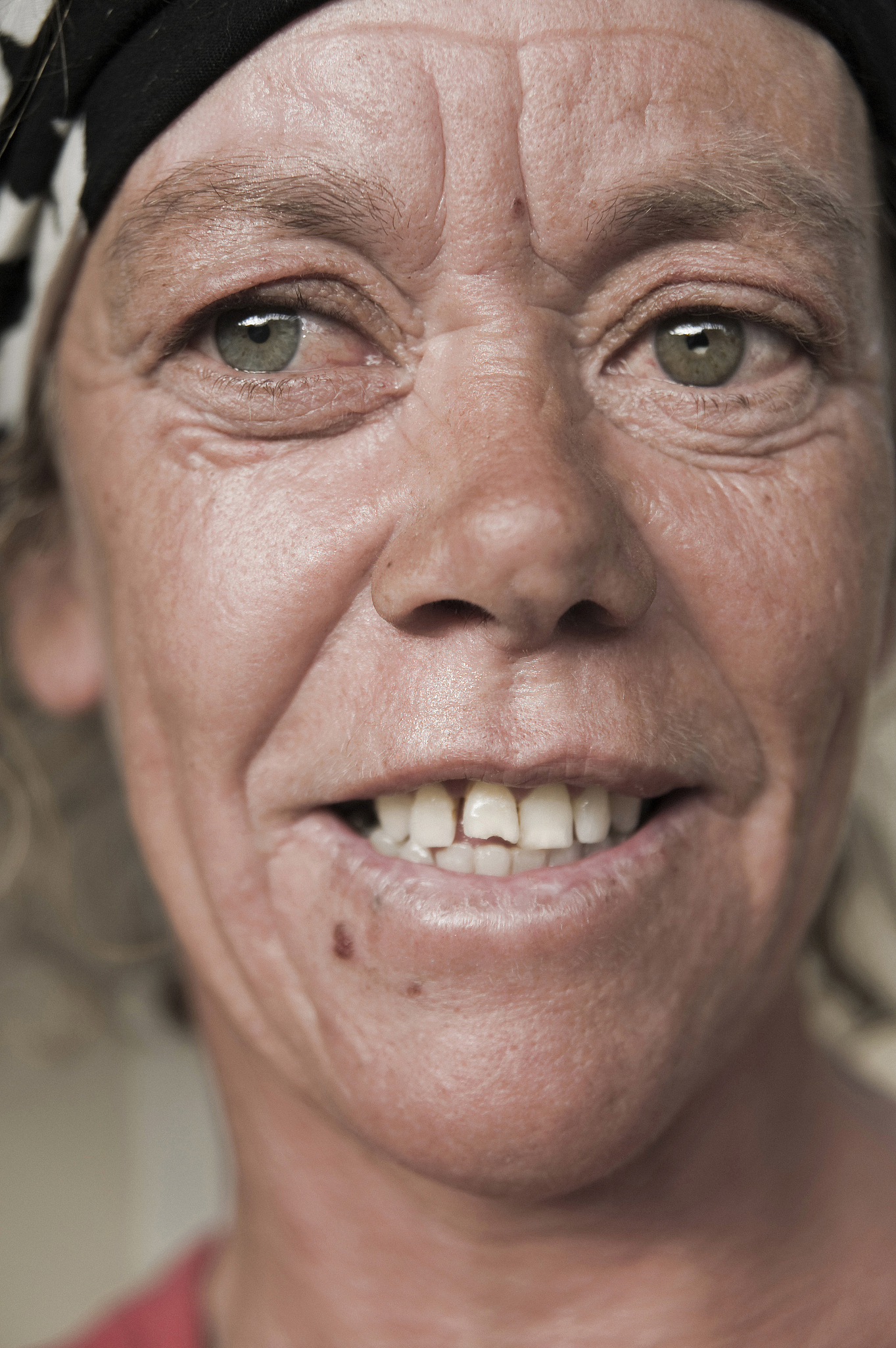 医美#   "印第安纹"通常是指法令纹或嘴角皱纹.