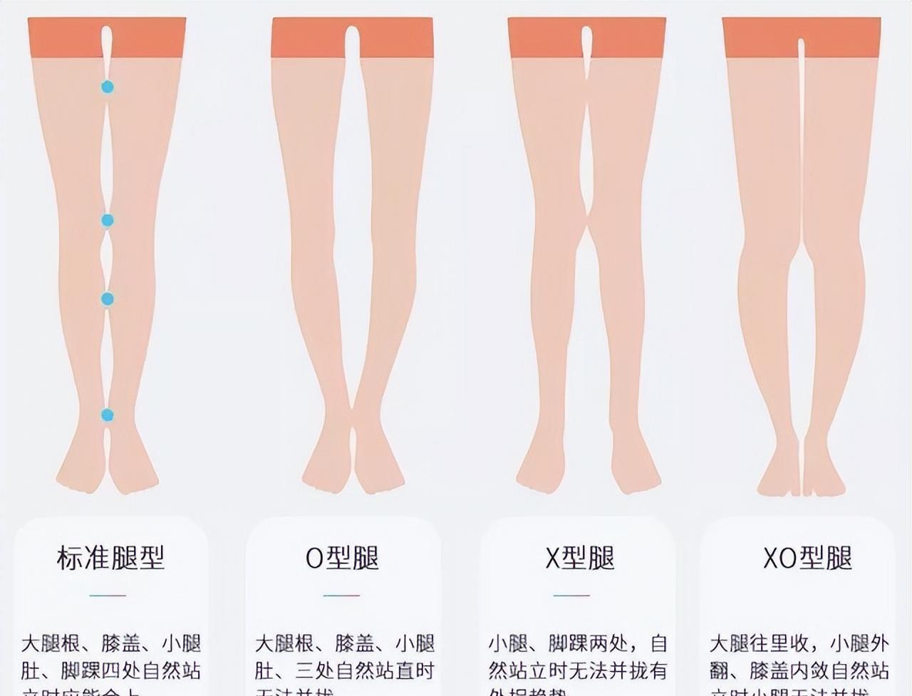 矫正方法:小时候矫正腿型最好.