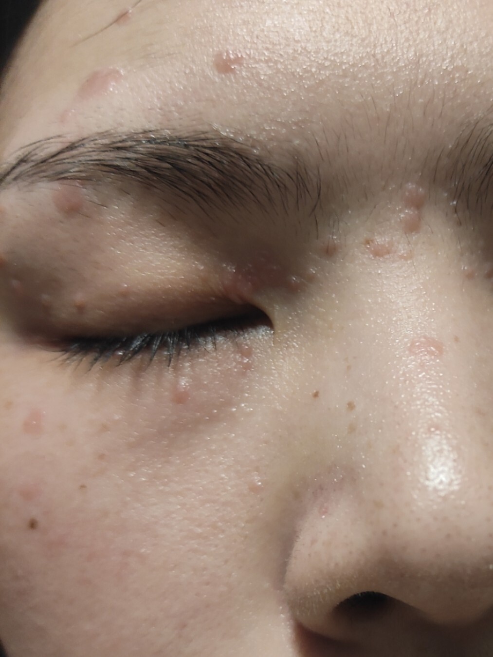 扁平疣治疗经验分享  上 小时候脸撞到没有粉刷的墙上,没有怎么处理