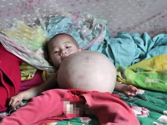 河南2岁女童怀孕肚大如鼓养父母千里求医不放弃结局如何了