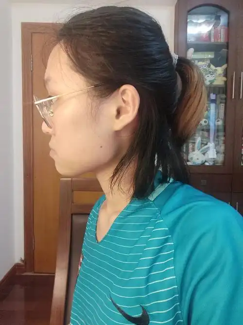 下颌骨突出真的是 还凸嘴 可我是天包地,是下巴的问题嘛 永远不敢侧面