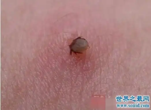 排名仅仅次于蚊子的世界第二传播疾病的是蜱虫,比跳蚤和虱子都强.