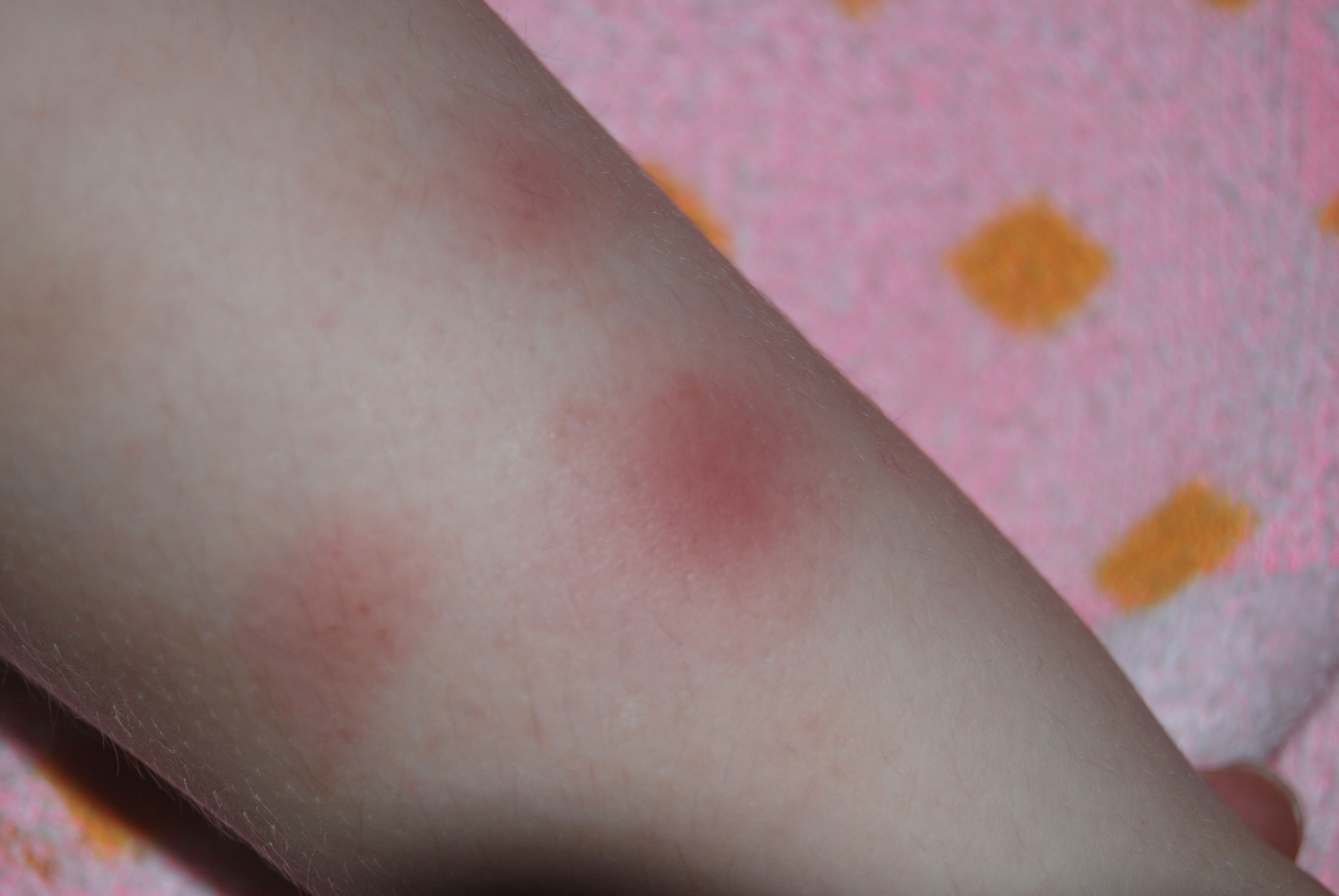 腿上突然出现红斑图片