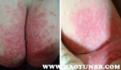 女宝宝,男宝宝尿布疹初期轻微和严重的症状图片大全
