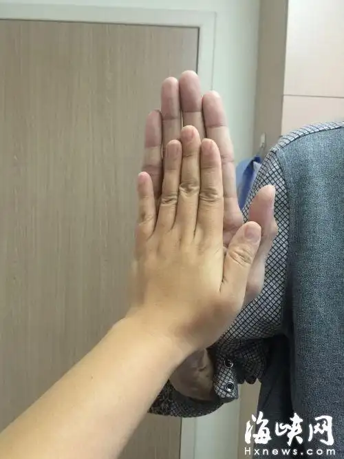 "蜘蛛人"的手指比记者长了好几厘米