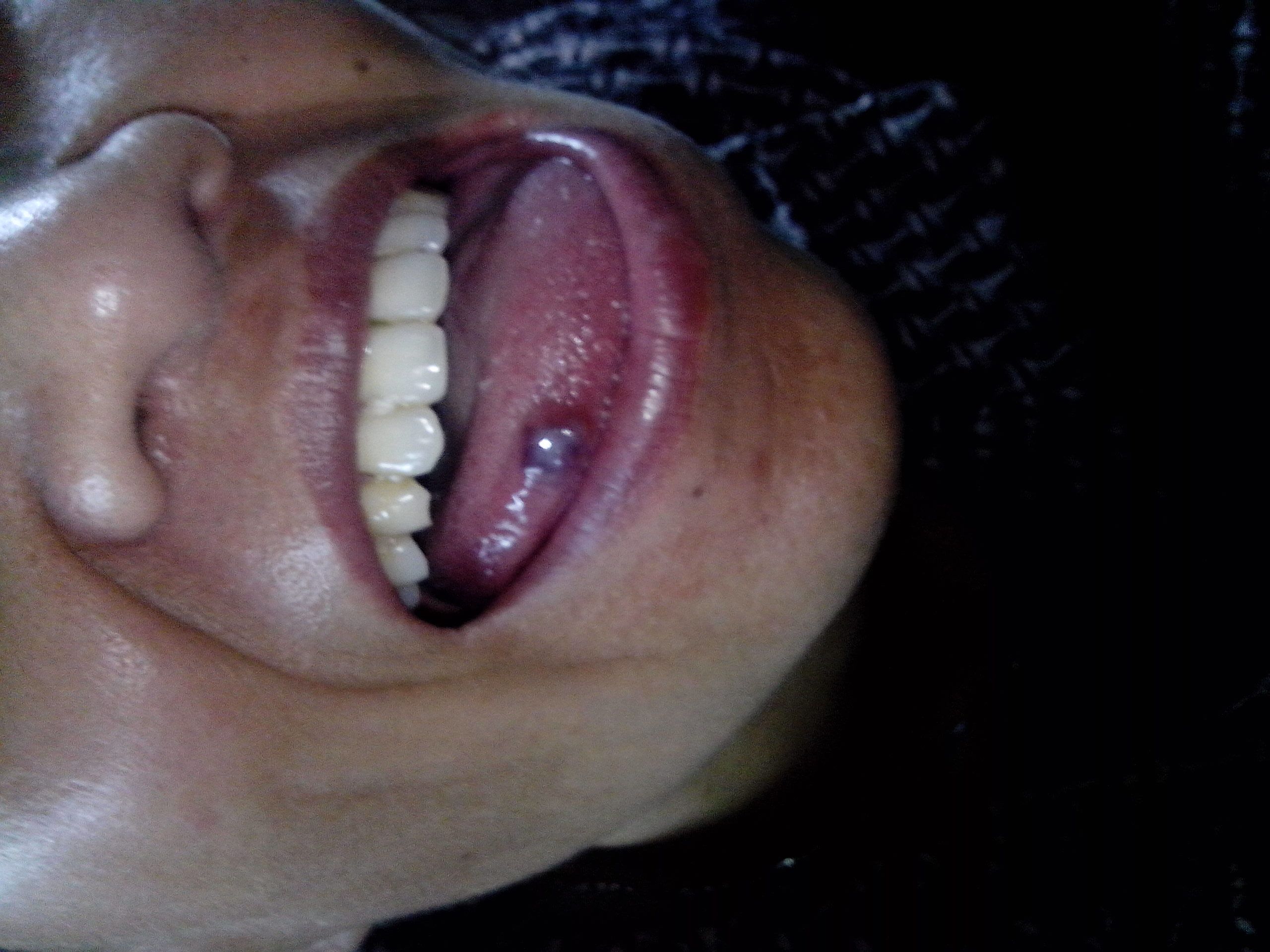 3,不疼.【不知道是不是因为几年前,吃东西,把舌头吃破了