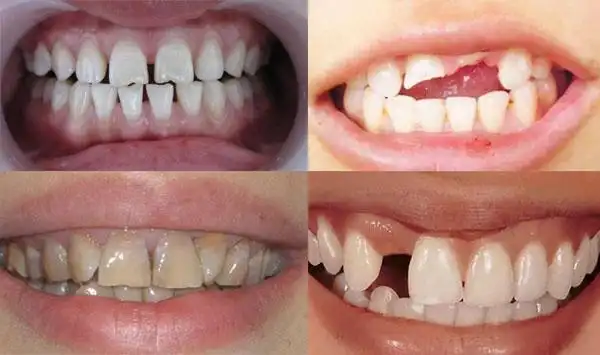 1,牙列形态异常如 牙缝过大,又不宜做正畸治疗的人群