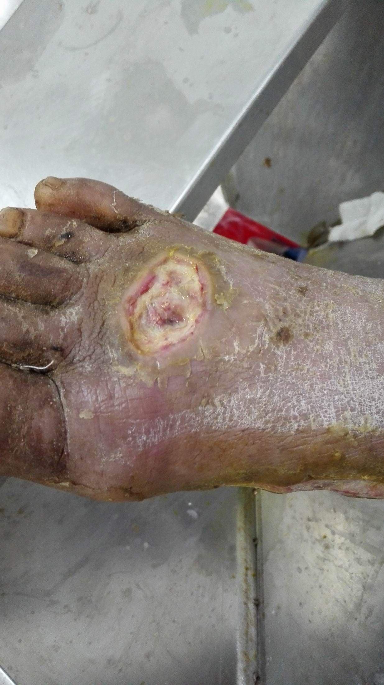 求助伤口一个多月肉芽组织半点不长