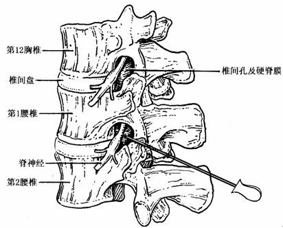 腰45和腰5骶1的椎间盘最容易突出,颈椎4/5和5/6最常见突出.