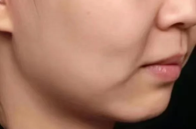 拍照时嘴角肌肉严重下垂,需要去除口角囊,看医美怎么做?