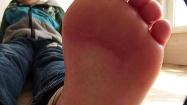 双侧脚掌部,肤色发红.老师帮忙看看