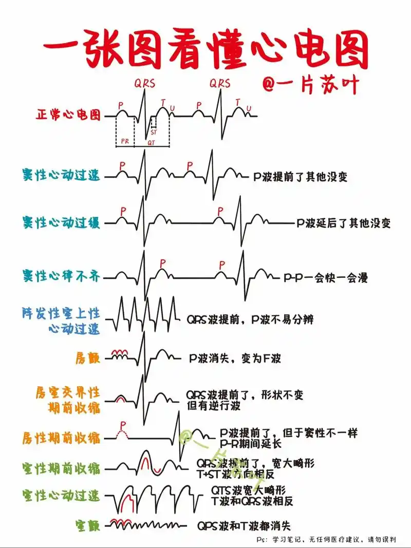 护士笔记73一张图学会心电图6015.