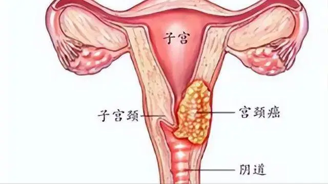 守护女性健康:宫颈癌防治中不容忽视哪些年龄段