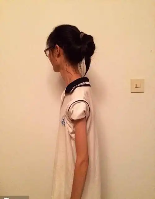 90后女孩跟风节食减肥失控瘦成晾衣杆为增肥花费40万