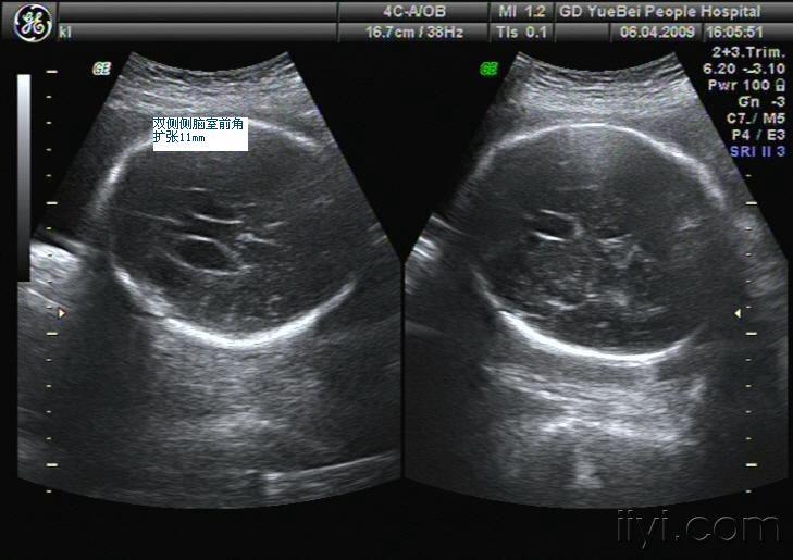 比较少见的胎儿侧脑室前角积液