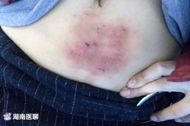 长沙一女子网购工具艾灸祛湿10天后皮肤烫成这样