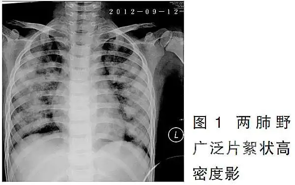 第42例特发性肺含铁血黄素沉着症iph