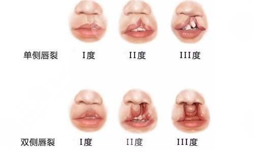 发生在婴儿出生后,是指从唇红到鼻孔,然后组织裂缝,这种情况称为唇裂