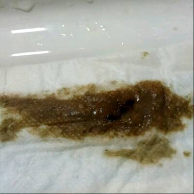 排卵期排出这样的,是什麼东西呀?