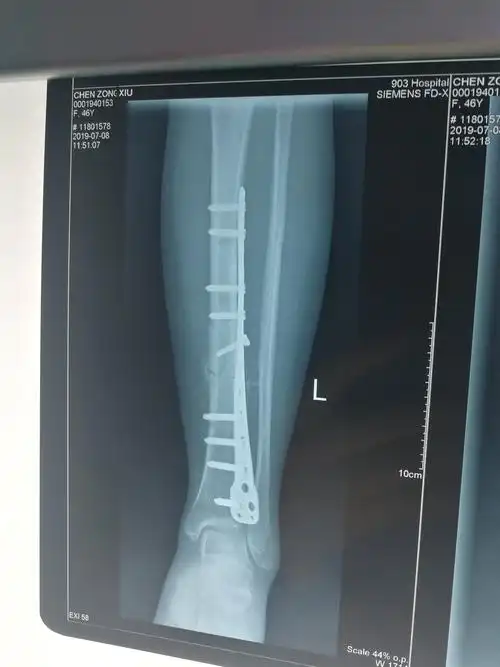 术后2月骨痂生长良好