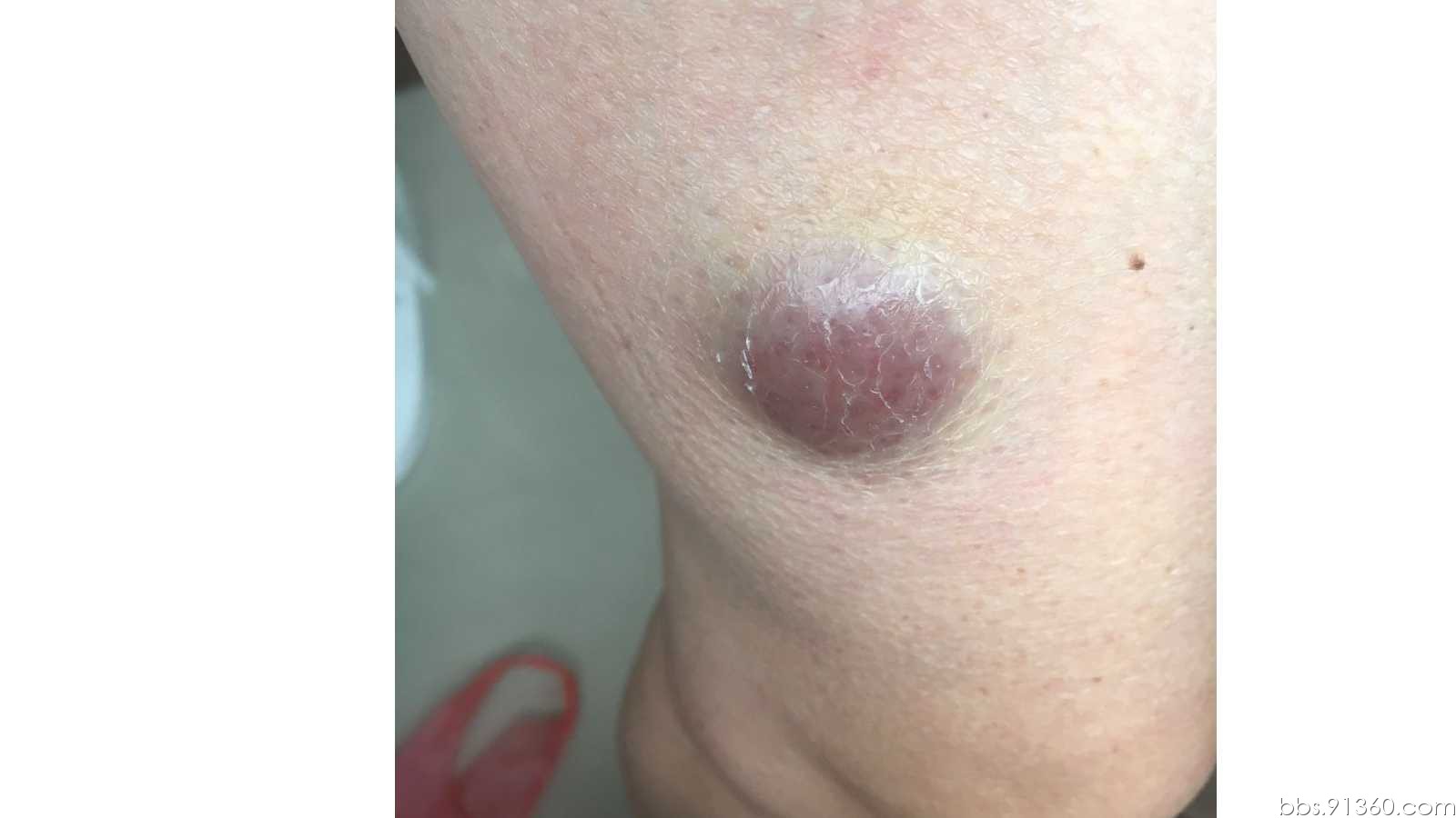 (右大腿)皮肤母细胞性浆细胞样树突细胞肿瘤【52086群第63题】