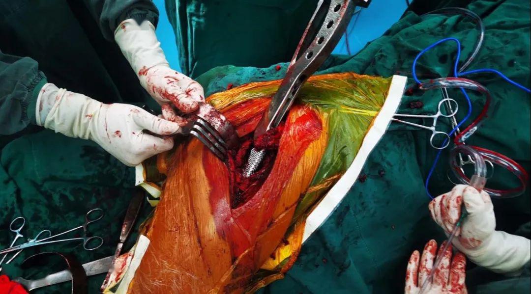 我院骨一科开展超高龄股骨转子间骨折骨水泥加长型人工股骨头置换术