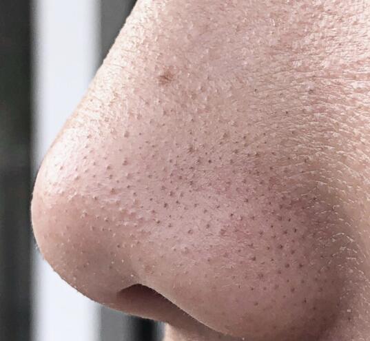 鼻子总是被黑头"纠缠",别再用指甲挤,试试这几招,黑头去无踪_毛孔