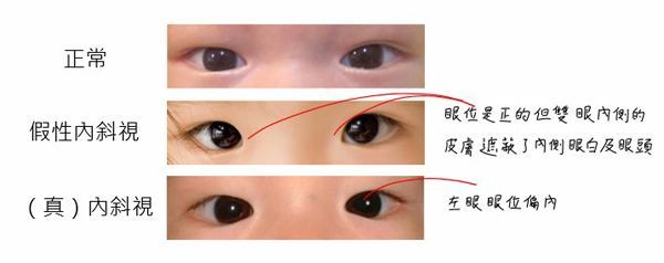 当我们在诊室如果碰到内斜视的患儿,我们会让家长先先回去给宝宝用